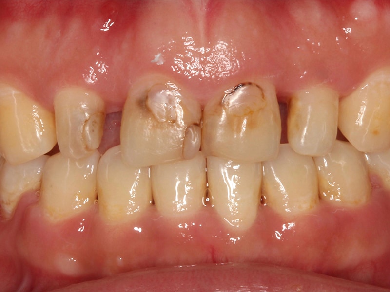 牙冠增長術改善笑齦，搭配全瓷貼片打造「完美微笑曲線」 2