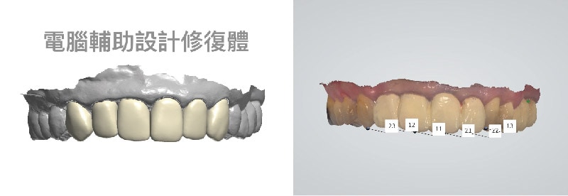 嚴重牙周病治療推薦: 療程包含全瓷冠/陶瓷貼片/植牙 5