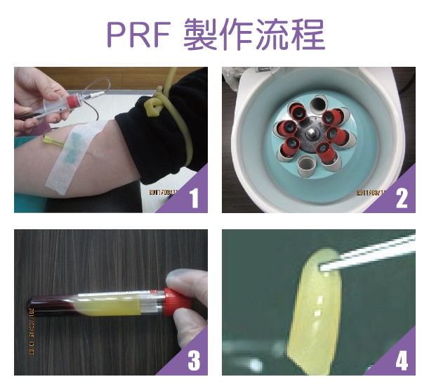 PRF富含血小板纖維蛋白 2