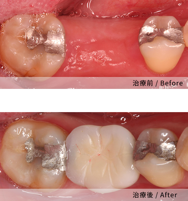 全程無痛的植牙過程 2
