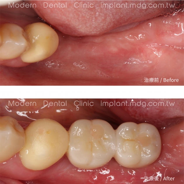 輕微牙周病治療推薦: 全口牙周病/牙齦萎縮/游離牙齦移植術 2