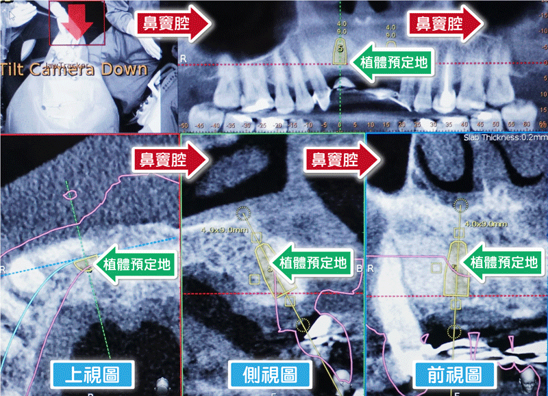 上顎門牙缺牙使用植牙導航之實際畫面